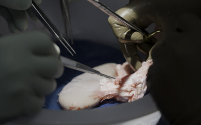 Pig Kidney Works A Record 2 Months In Donated Body