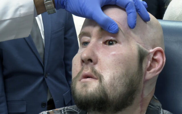 Man Receives The First Eye Transplant